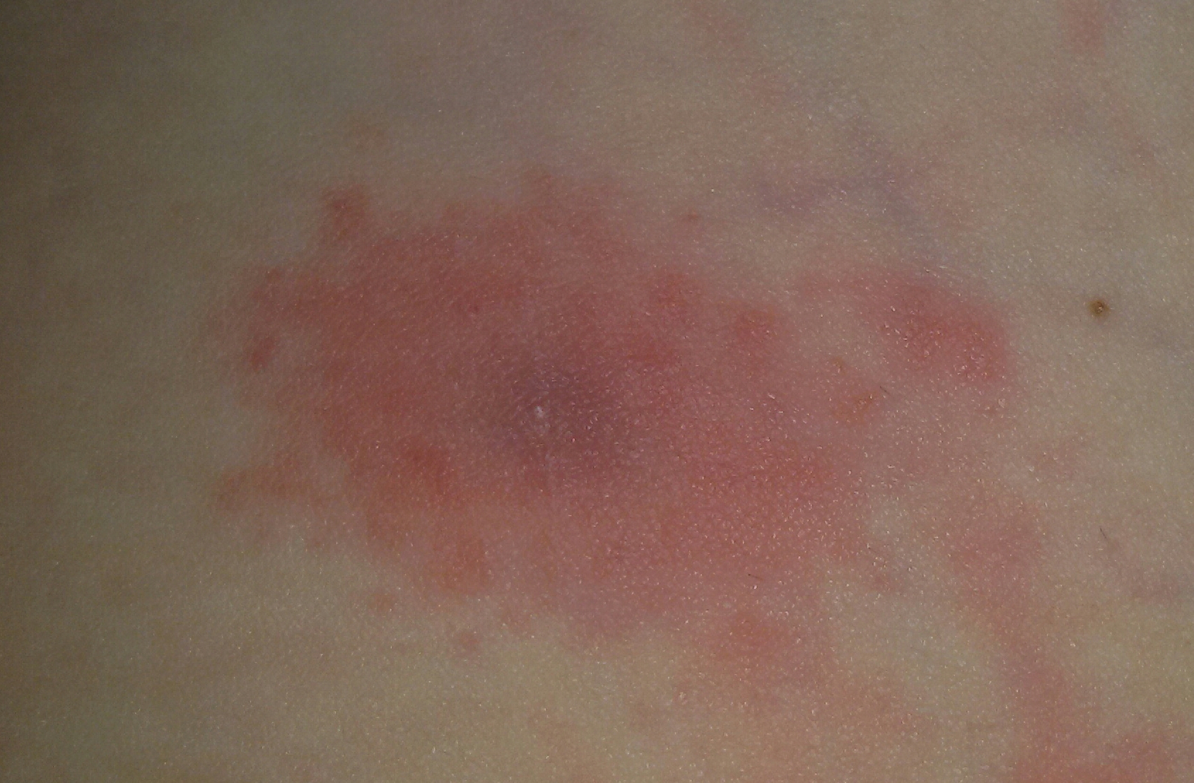 ist das hier auf dem Photo eine Wanderröte? (Zeckenbiss, Borreliose)